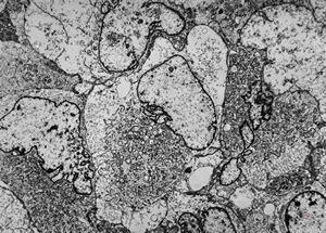 F,76y. | unspecified sarcoma (myocarcoma v.s.) - calf F,76y. | unspecified sarcoma (myocarcoma v.s.) - calf